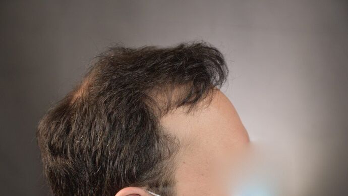 FUT Hair Restoration: Case 15 - After