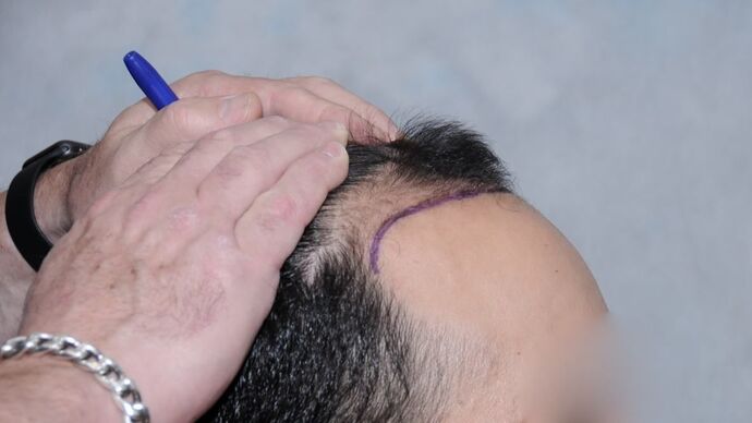 FUT Hair Restoration: Case 15 - Before