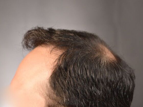 FUT Hair Restoration: Case 15 - After