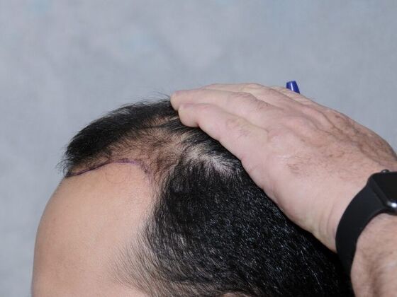 FUT Hair Restoration: Case 15 - Before