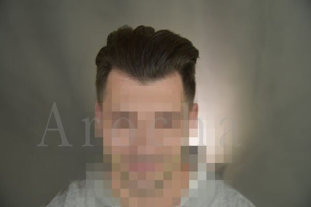 FUT Hair Restoration: Case 16 - After