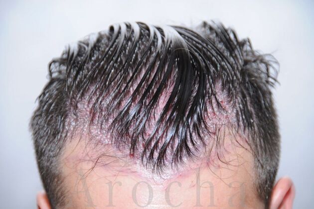 FUT Hair Restoration: Case 16 - Before