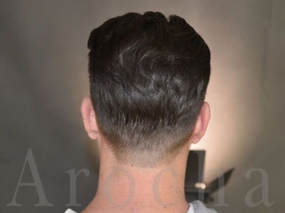 FUT Hair Restoration: Case 16 - After