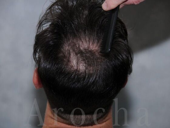 FUT Hair Restoration: Case 16 - Before