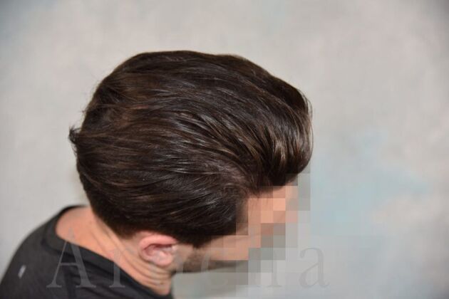 FUT Hair Restoration: Case 16 - After