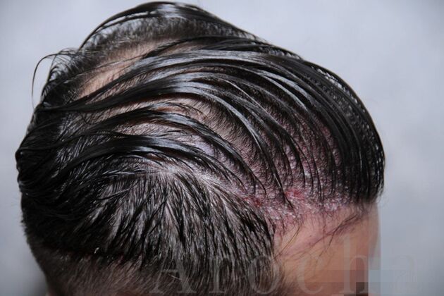 FUT Hair Restoration: Case 16 - Before