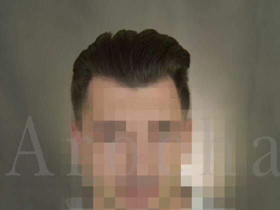 FUT Hair Restoration: Case 16 - After