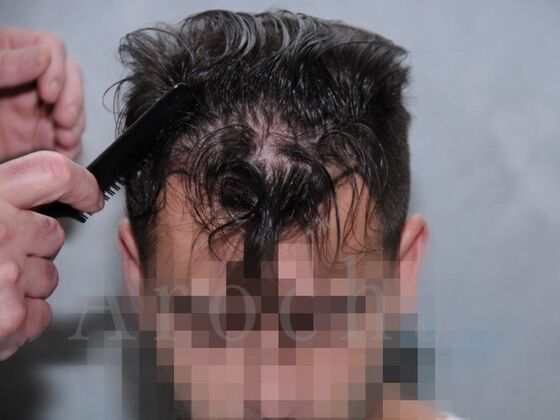 FUT Hair Restoration: Case 16 - Before