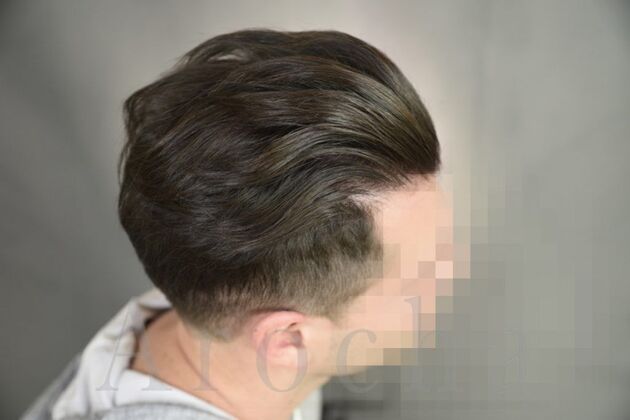 FUT Hair Restoration: Case 16 - After