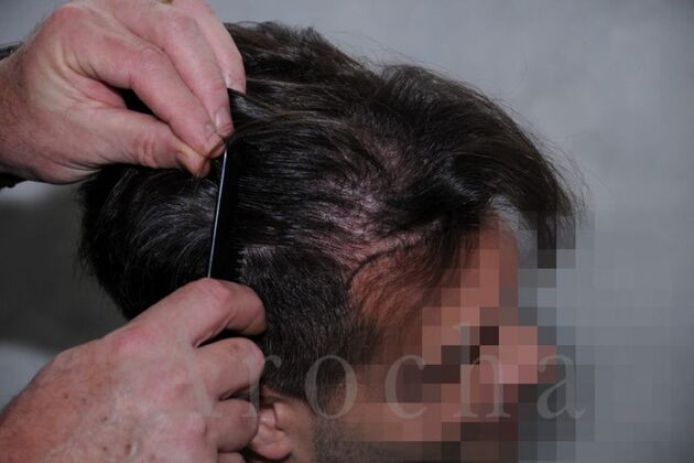 FUT Hair Restoration: Case 16 - Before