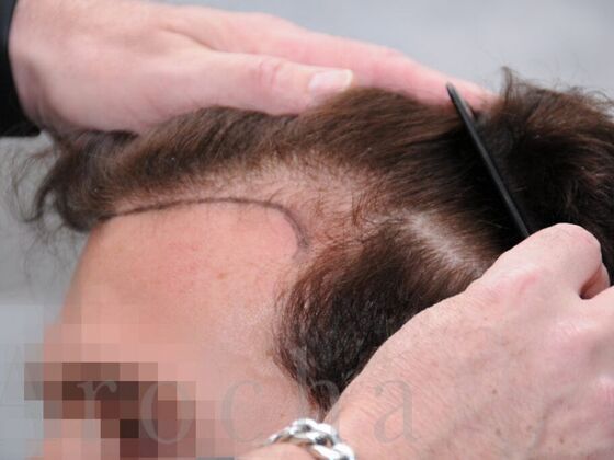 FUT Hair Restoration: Case 17 - Before