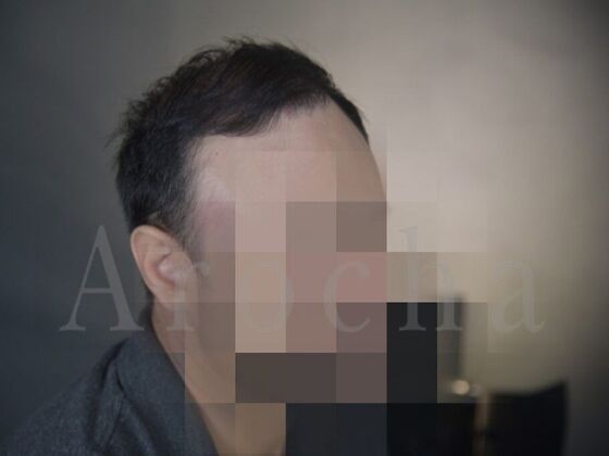 FUT Hair Restoration Case 18 - After