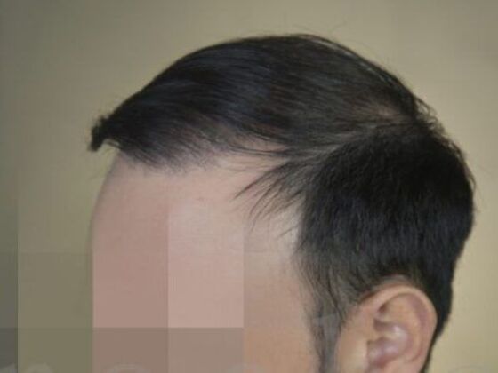 FUT Hair Restoration: Case 18 - After