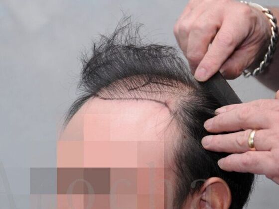 FUT Hair Restoration: Case 18 - Before