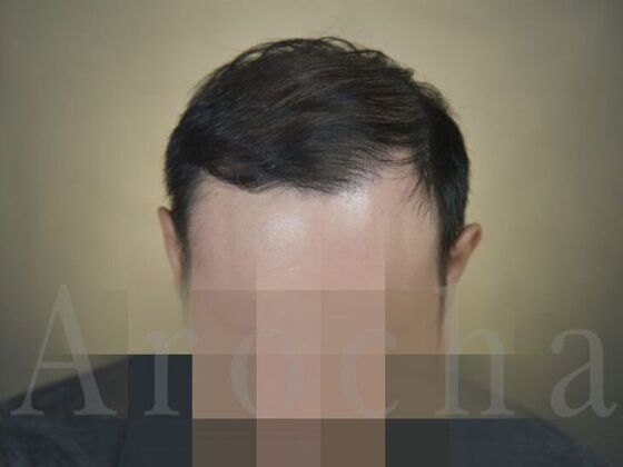 FUT Hair Restoration: Case 18 - After