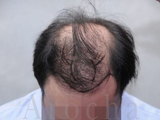 FUT Hair Restoration: Case 18 - Before