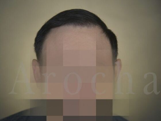 FUT Hair Restoration: Case 18 - After