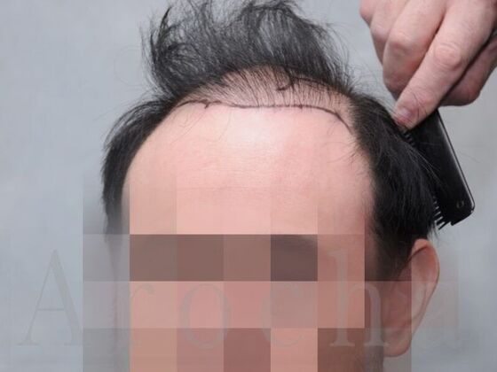 FUT Hair Restoration: Case 18 - Before