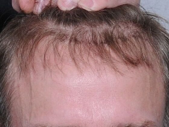 FUT Hair Restoration Case 19 - Before