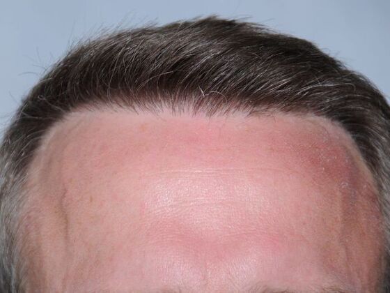 FUT Hair Restoration Case 19 - After