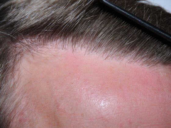 FUT Hair Restoration: Case 19 - After