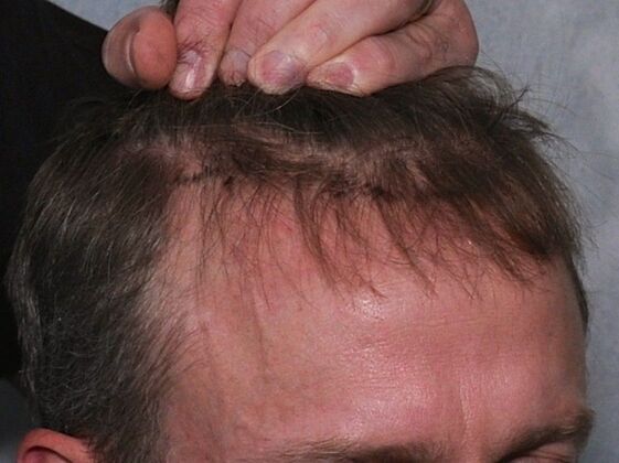 FUT Hair Restoration: Case 19 - Before