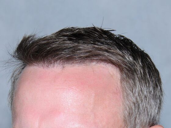 FUT Hair Restoration: Case 19 - After