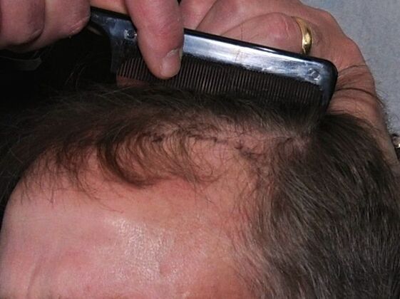 FUT Hair Restoration: Case 19 - Before