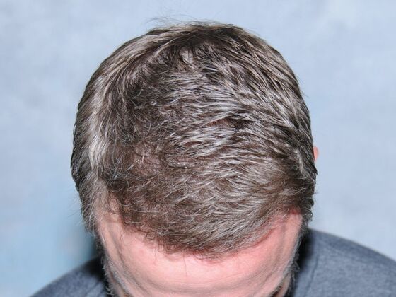 FUT Hair Restoration: Case 19 - After