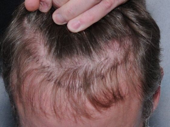 FUT Hair Restoration: Case 19 - Before