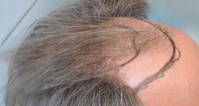 FUT Hair Restoration: Case 20 - Before