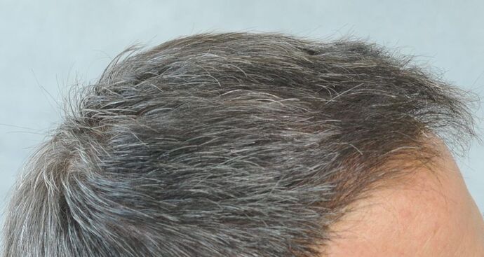 FUT Hair Restoration: Case 20 - After