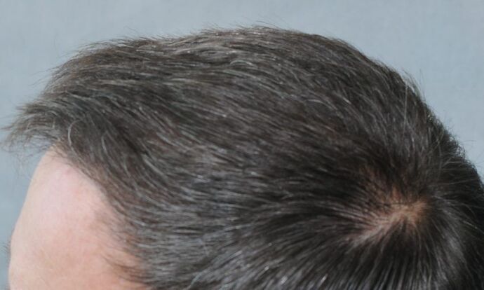 FUT Hair Restoration: Case 20 - After