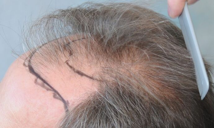 FUT Hair Restoration: Case 20 - Before