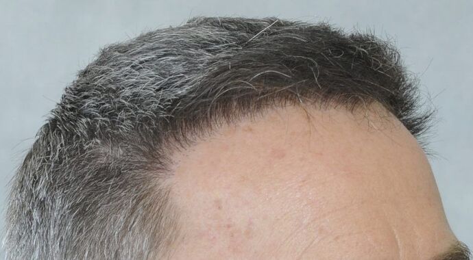 FUT Hair Restoration: Case 20 - After