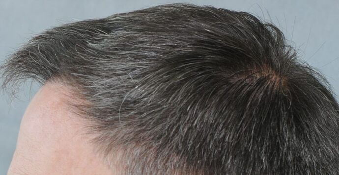 FUT Hair Restoration: Case 20 - After