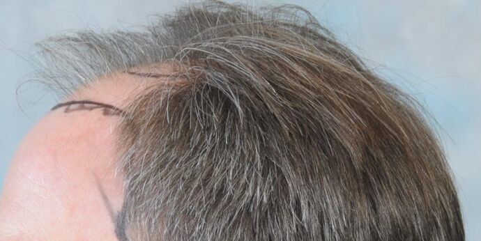 FUT Hair Restoration: Case 20 - Before