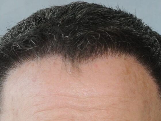 FUT Hair Restoration Case 20 - After