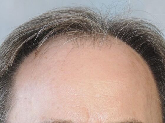 FUT Hair Restoration Case 20 - Before