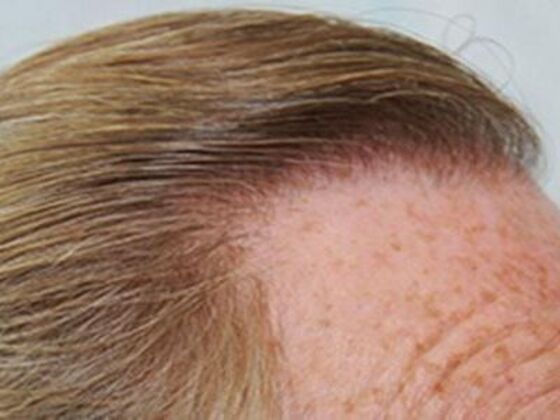 FUT Hair Restoration Case 21 - After