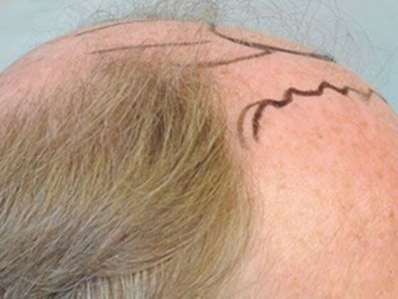 FUT Hair Restoration Case 21 - Before