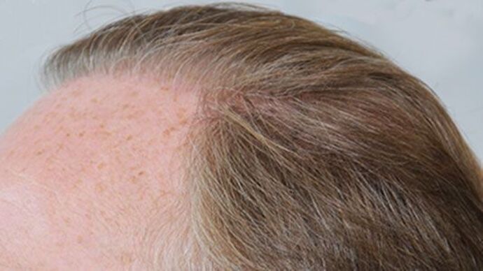 FUT Hair Restoration: Case 21 - After