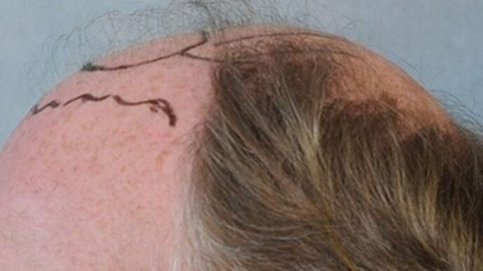 FUT Hair Restoration: Case 21 - Before