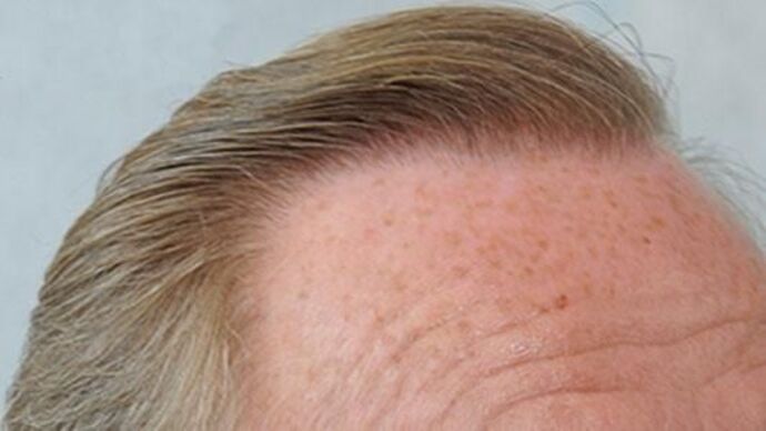 FUT Hair Restoration: Case 21 - After