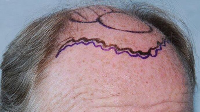 FUT Hair Restoration: Case 21 - Before