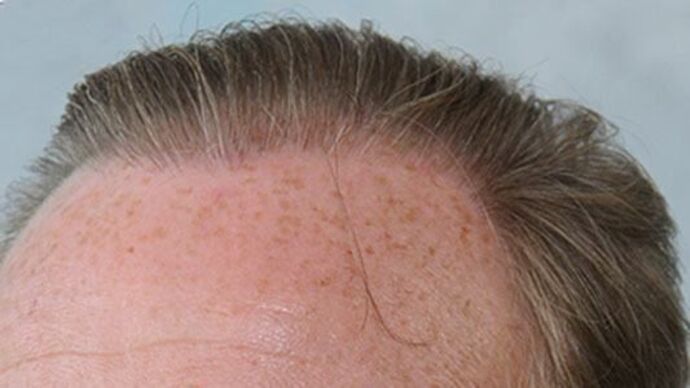 FUT Hair Restoration: Case 21 - After