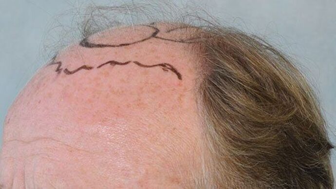 FUT Hair Restoration: Case 21 - Before