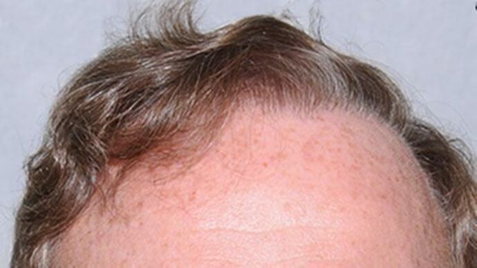 FUT Hair Restoration: Case 21 - After