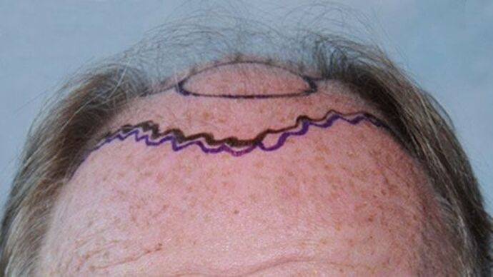 FUT Hair Restoration: Case 21 - Before