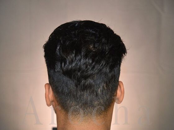 FUE Hair Restoration: Case 4 - After